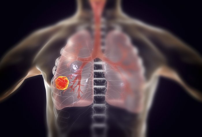 Screening for lung cancer.